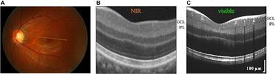 In vivo Morphometry of Inner Plexiform Layer (IPL) Stratification in the Human Retina With Visible Light Optical Coherence Tomography